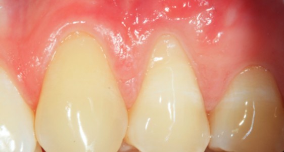 Formation courte chirurgie micro-gingivale Université Nice